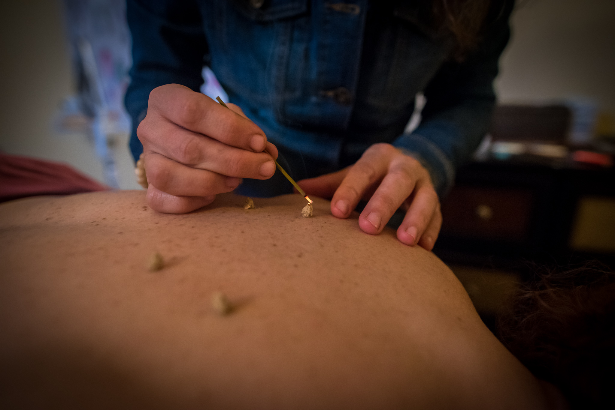 moxibustion therapy