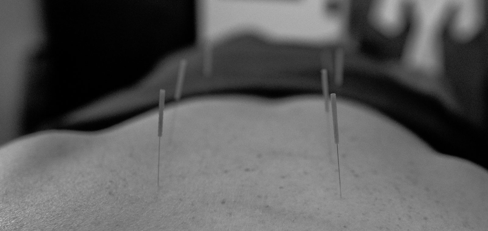acupuncture needles in back